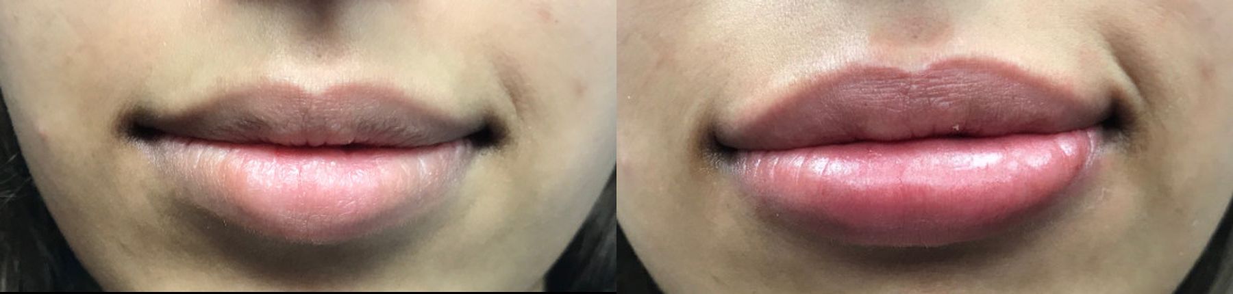 Before and after Restylane® Silk case 36497
