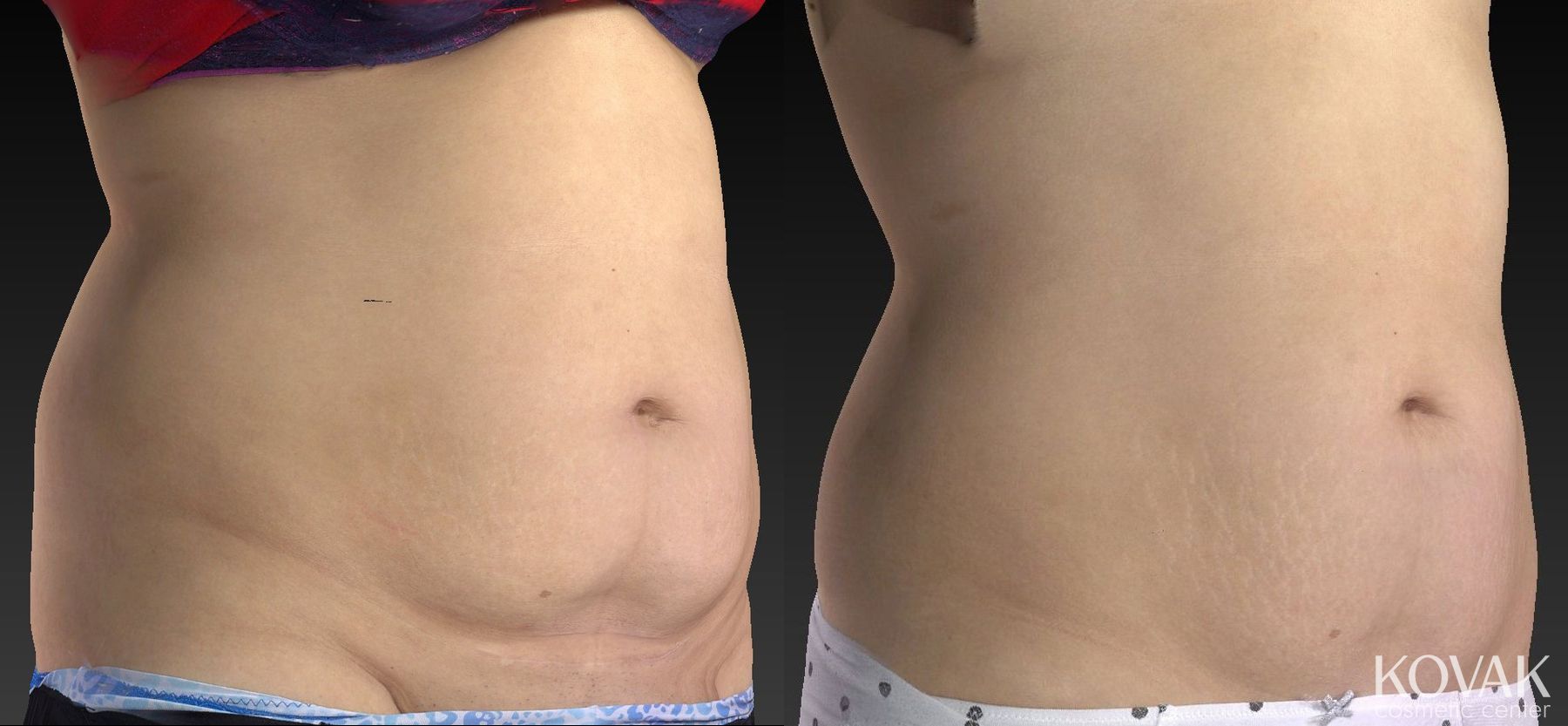 Before and after CoolSculpting® case 36602 - Angle 5