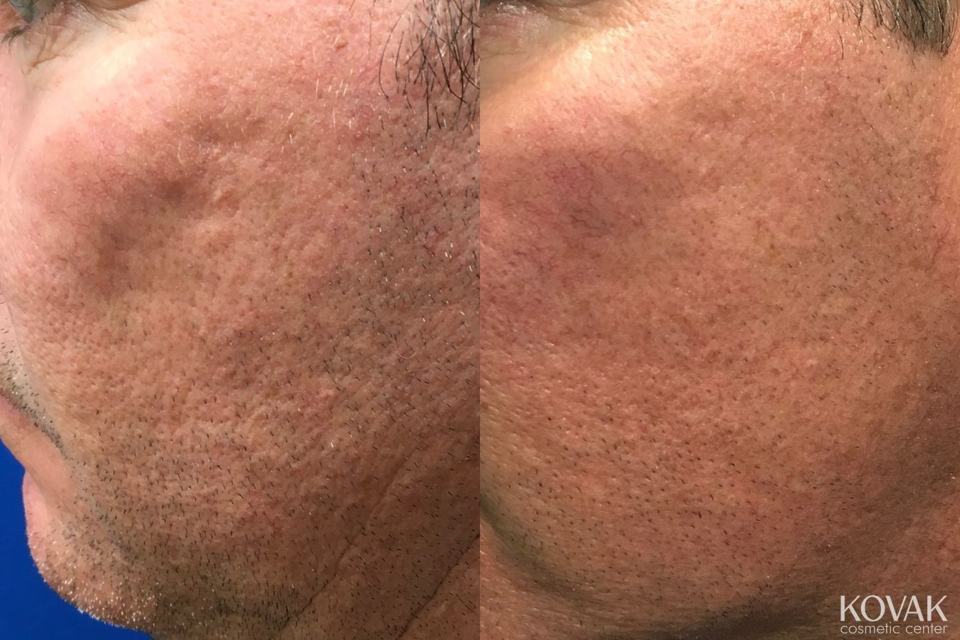 Before and after Acne Scars case 36458 - Angle 2