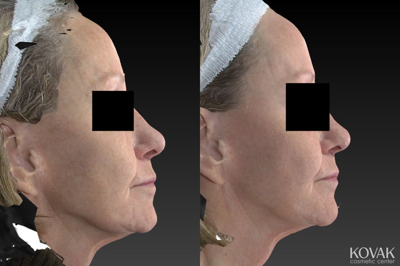 Before and after Halo™ case 36482