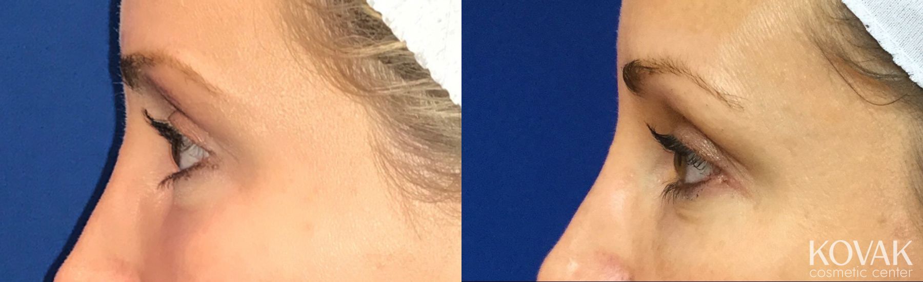 Before and after ThermiSmooth® case 36586 - Angle 2