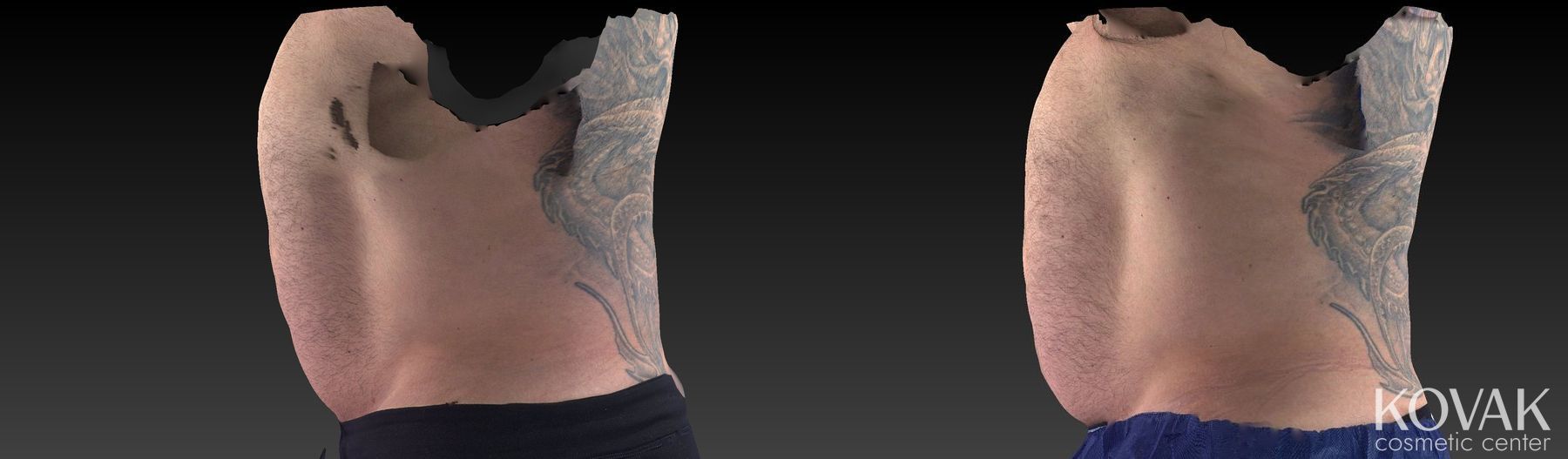 Before and after CoolSculpting® case 36562 - Angle 5