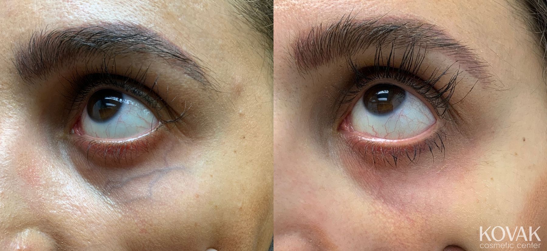 Before and after Eye Vein Treatment case 36712