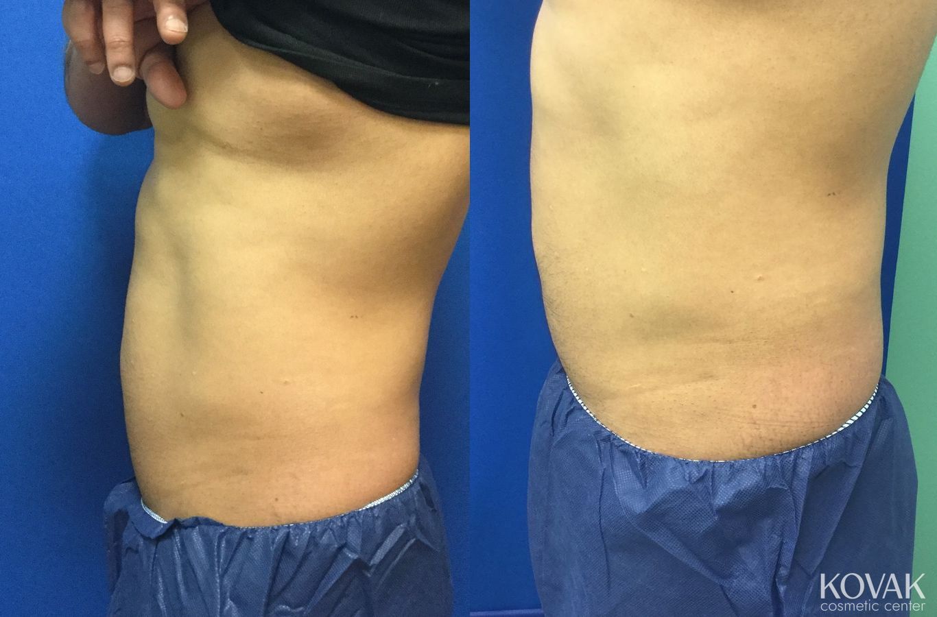 Before and after EMSCULPTĀ® case 36600 - Angle 2