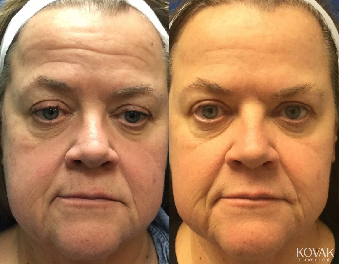 Before and after Restylane® Silk case 36645