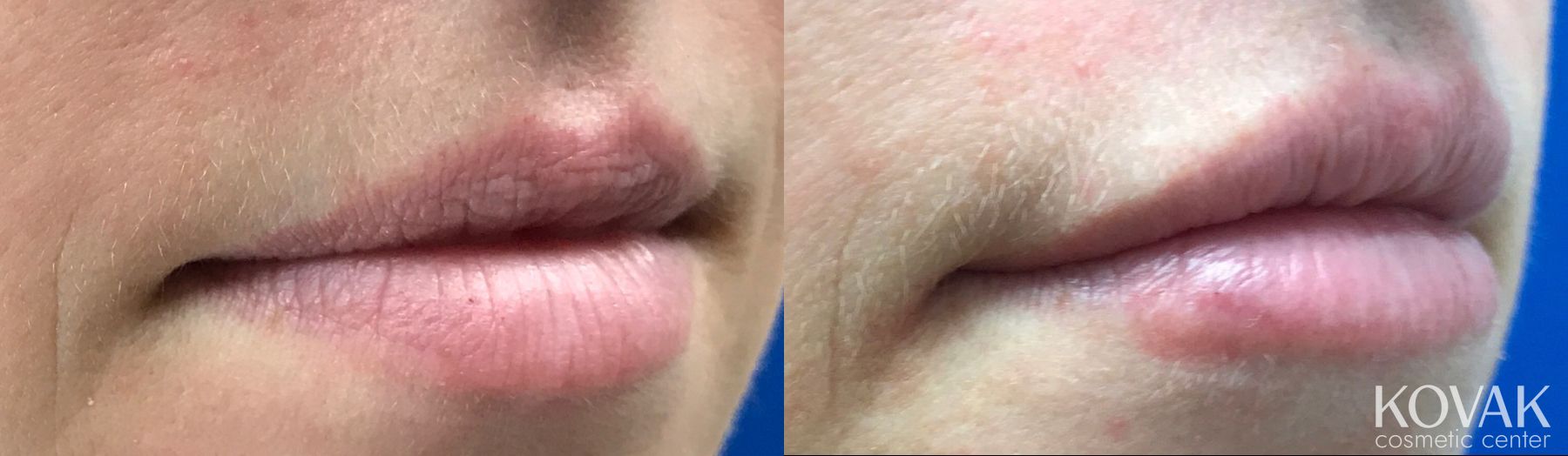 Before and after Restylane® case 36598 - Angle 2