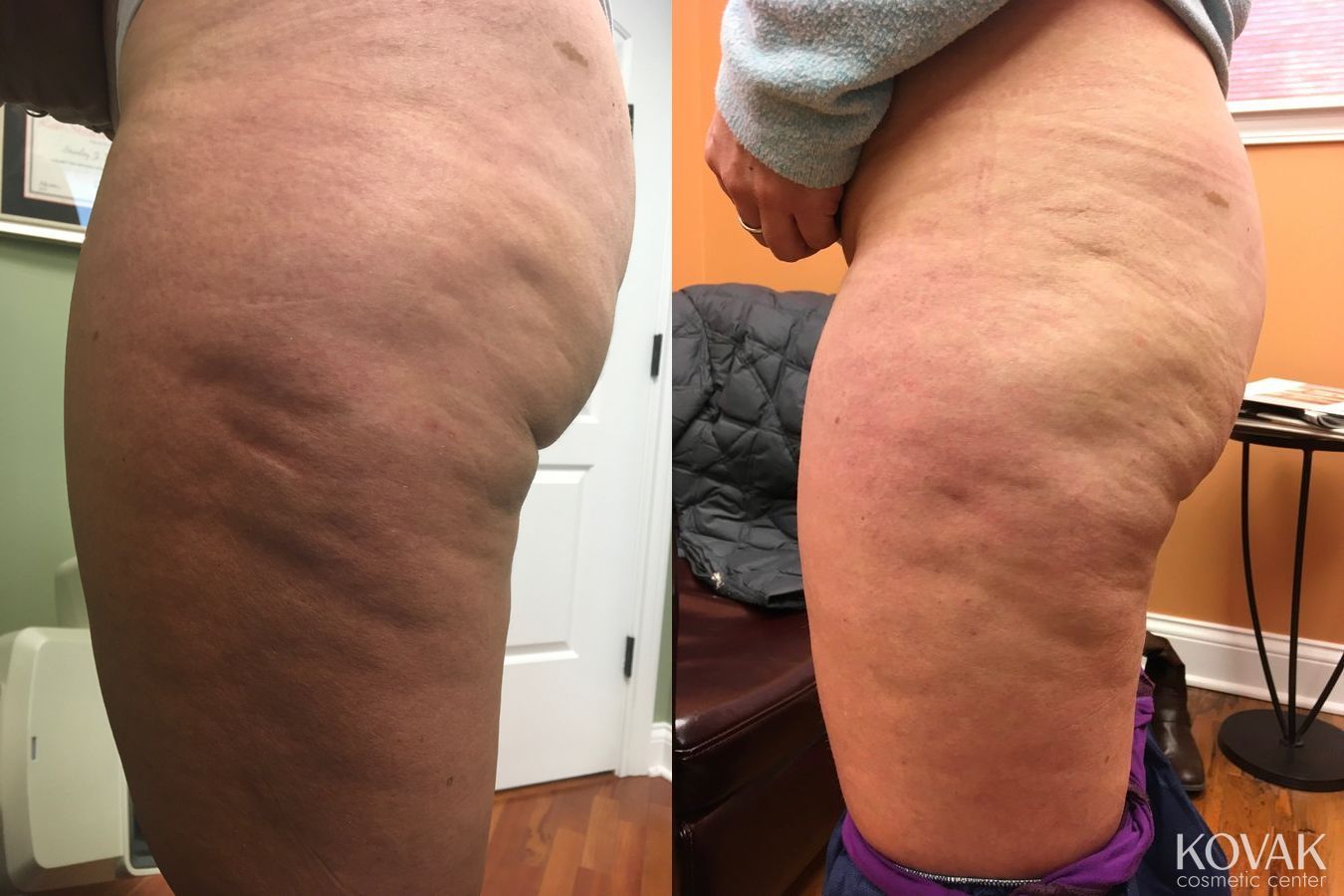 Before and after Cellulite Reduction case 36526 - Angle 2