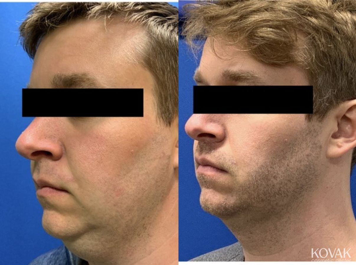 Before and after VLR - Vaser Laser - Jawline Sculpting case 36766 - Angle 4