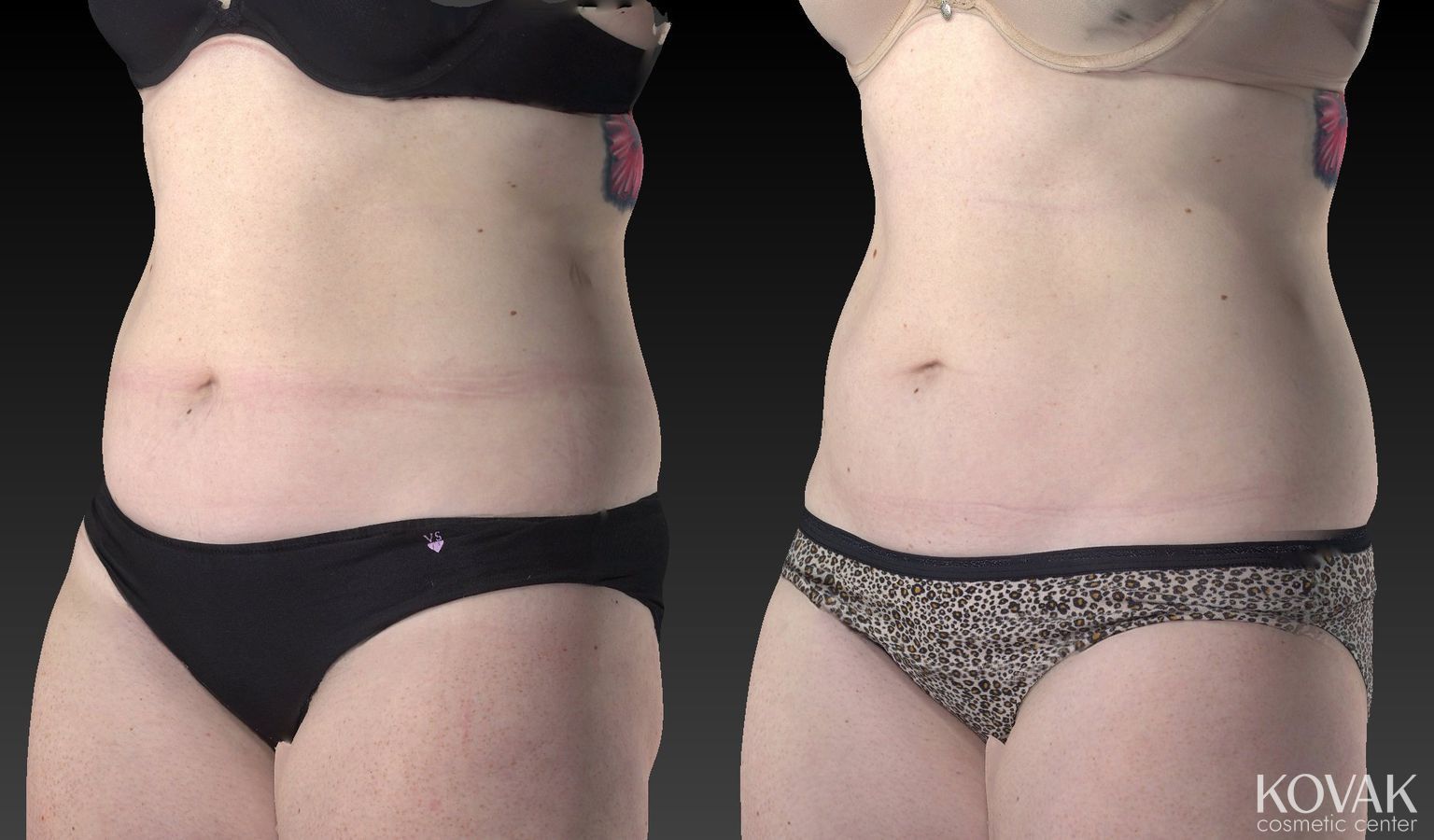 Before and after CoolSculpting® case 36604 - Angle 4