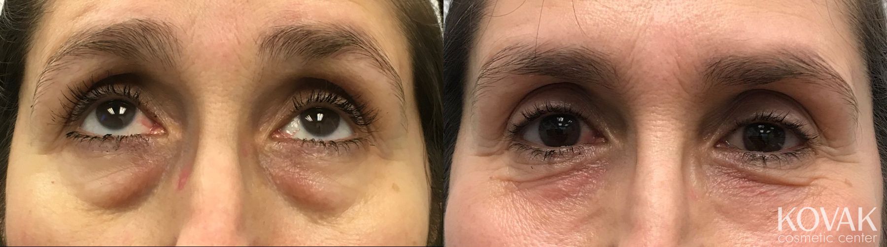 Before and after Restylane® Silk case 36551