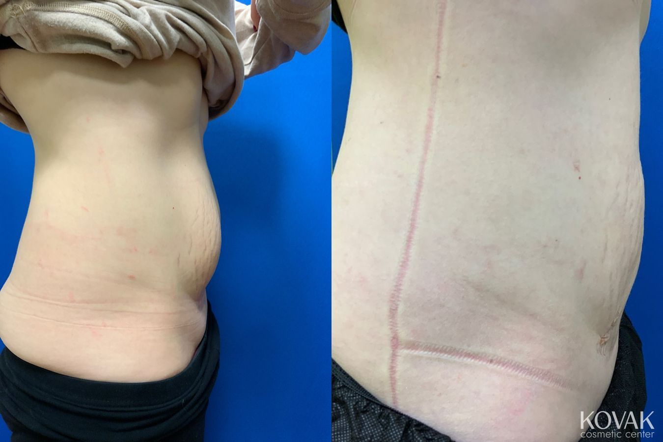Before and after Laser Liposuction case 36725 - Angle 3