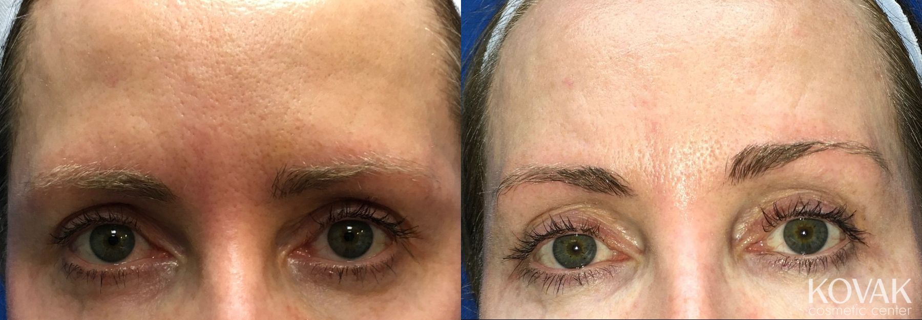 Before and after Eye Treatments case 36682