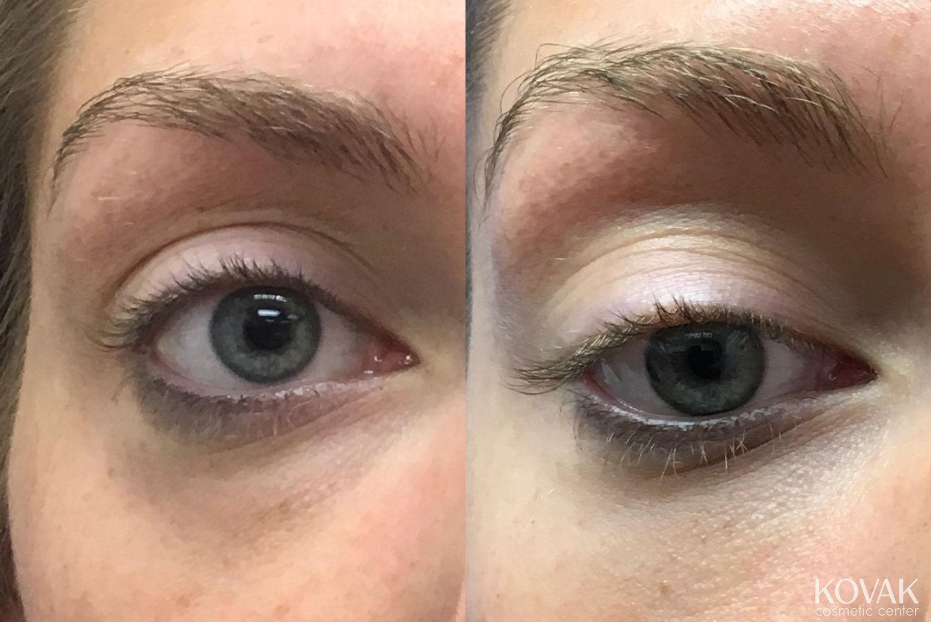 Before and after Eye Treatments case 36601