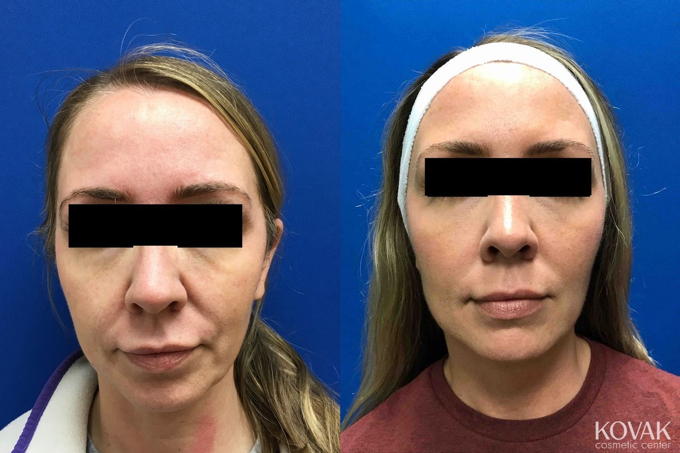 Before and after Sculptra® case 36655