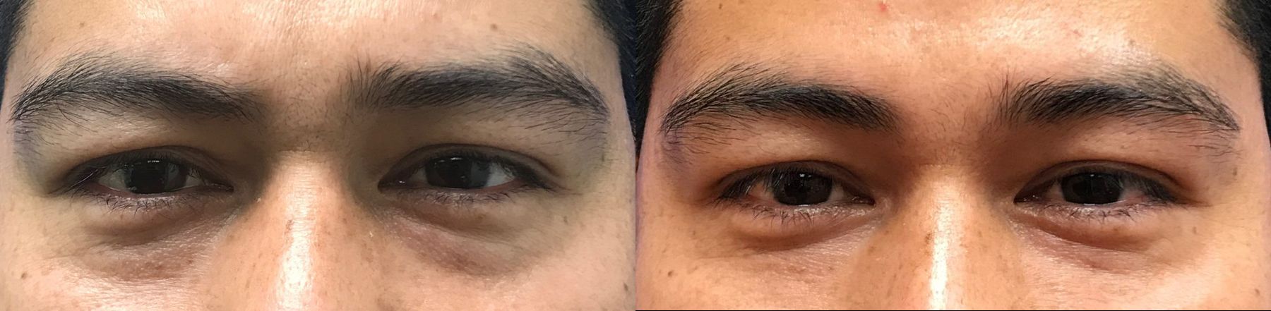 Before and after Injectables - Face case 36591