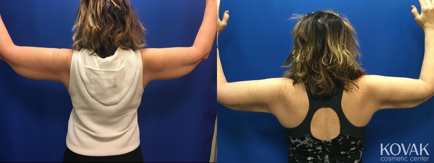 Before and after Laser Liposuction case 36681 - Angle 2