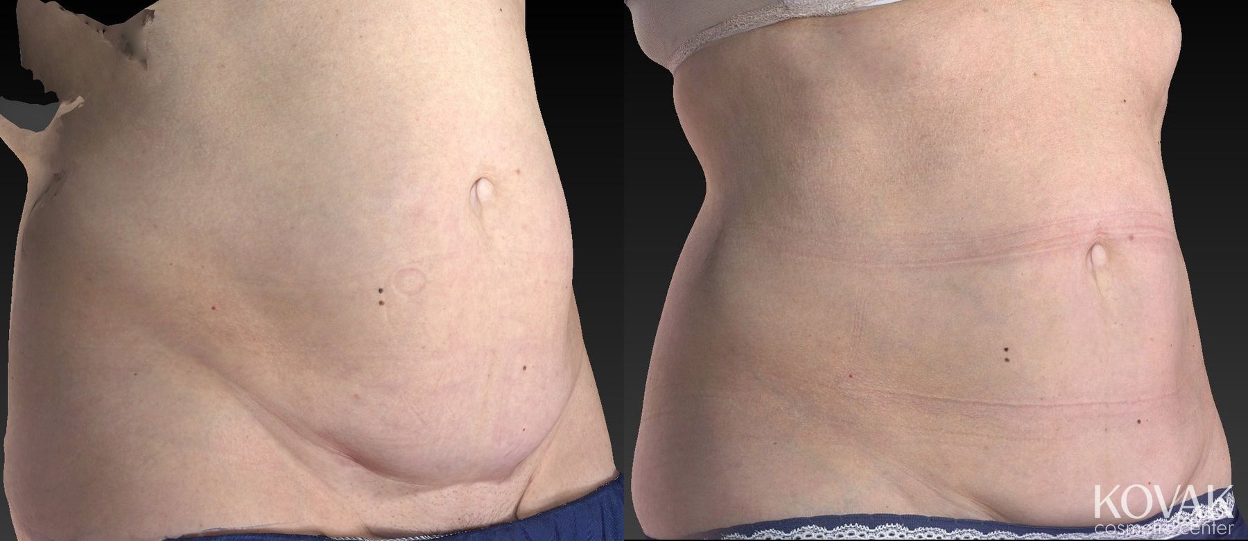 Before and after CoolSculpting® case 36485 - Angle 2