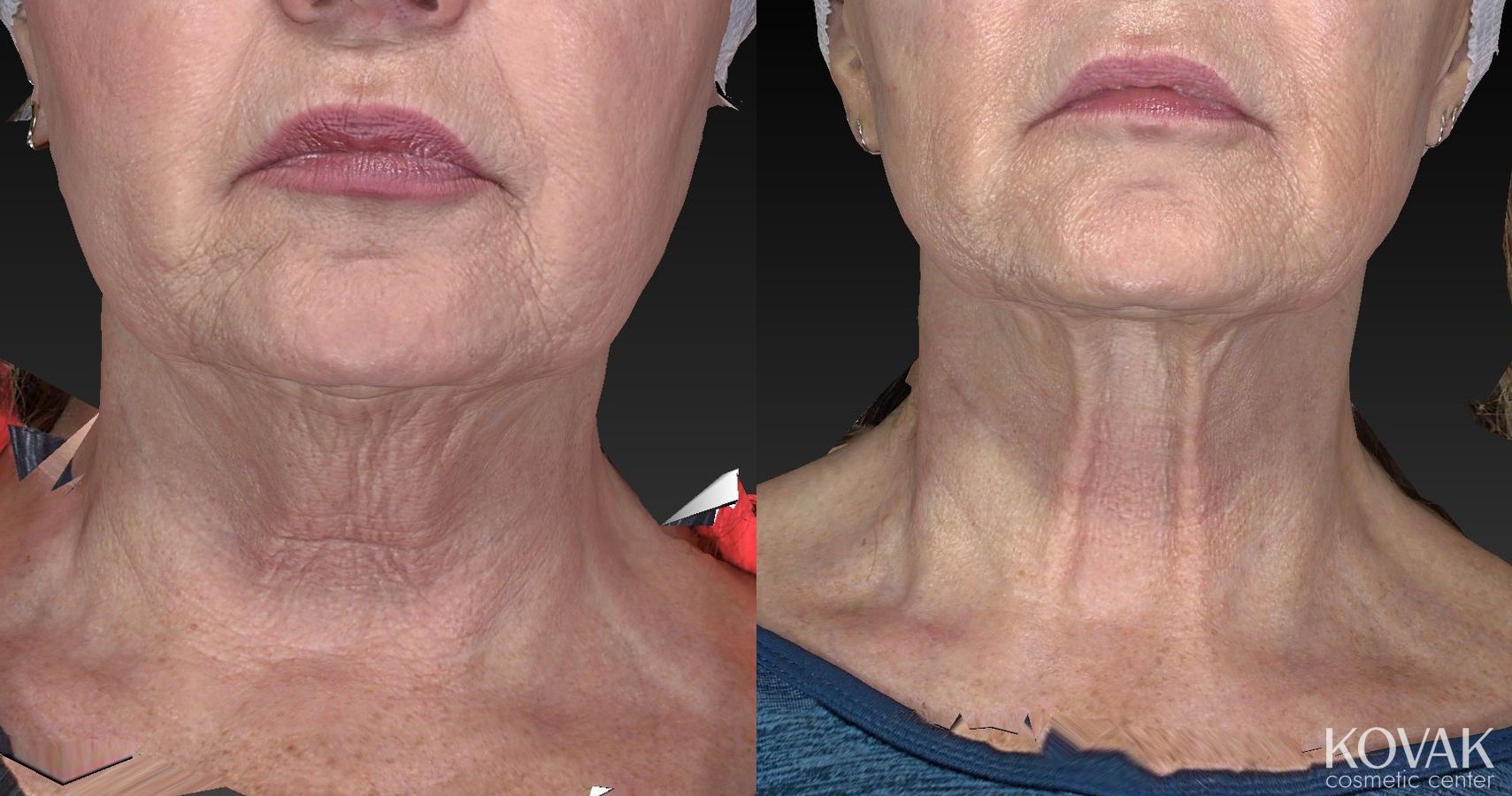 Before and after Kybella case 36483