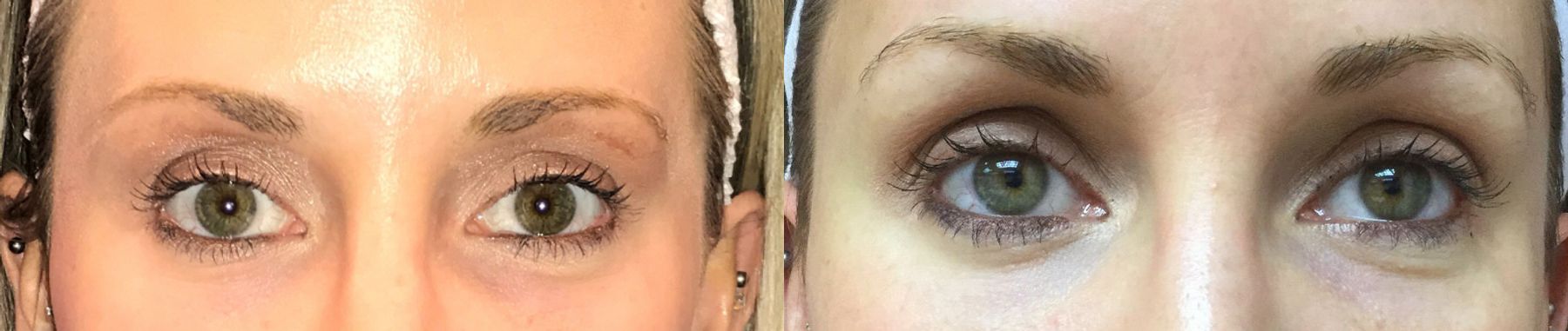 Before and after ThermiSmooth® case 36586