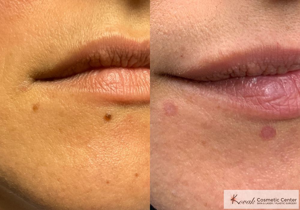 Mole Removal - Case 1664