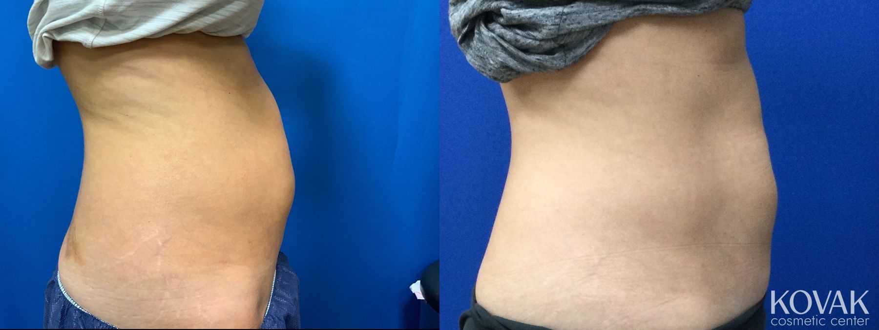 Before and after CoolSculpting® case 36726 - Angle 2