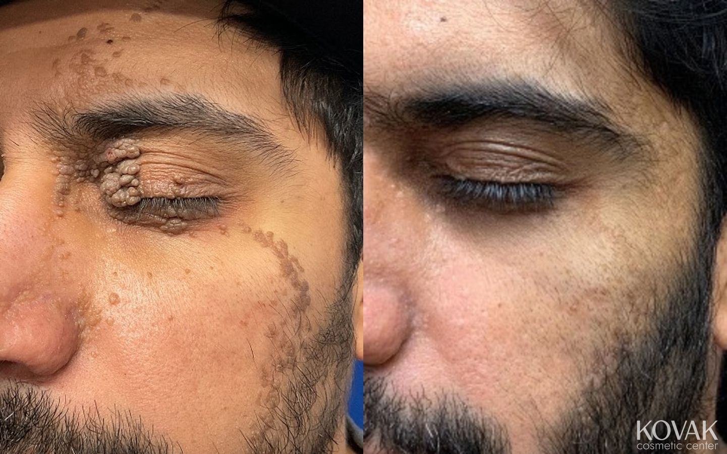 Before and after Mole Removal case 36730