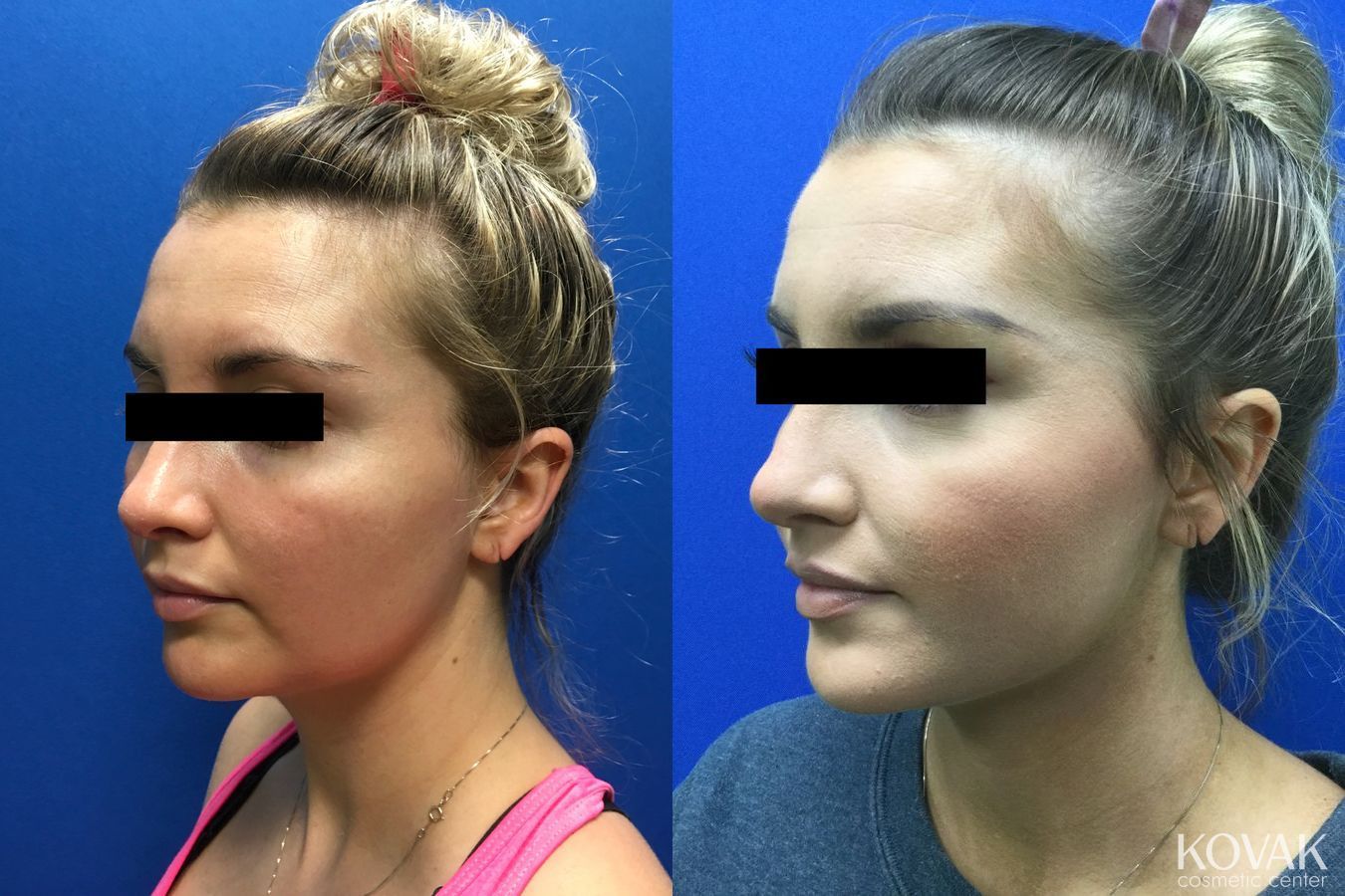Before and after Laser Liposuction case 36705 - Angle 3