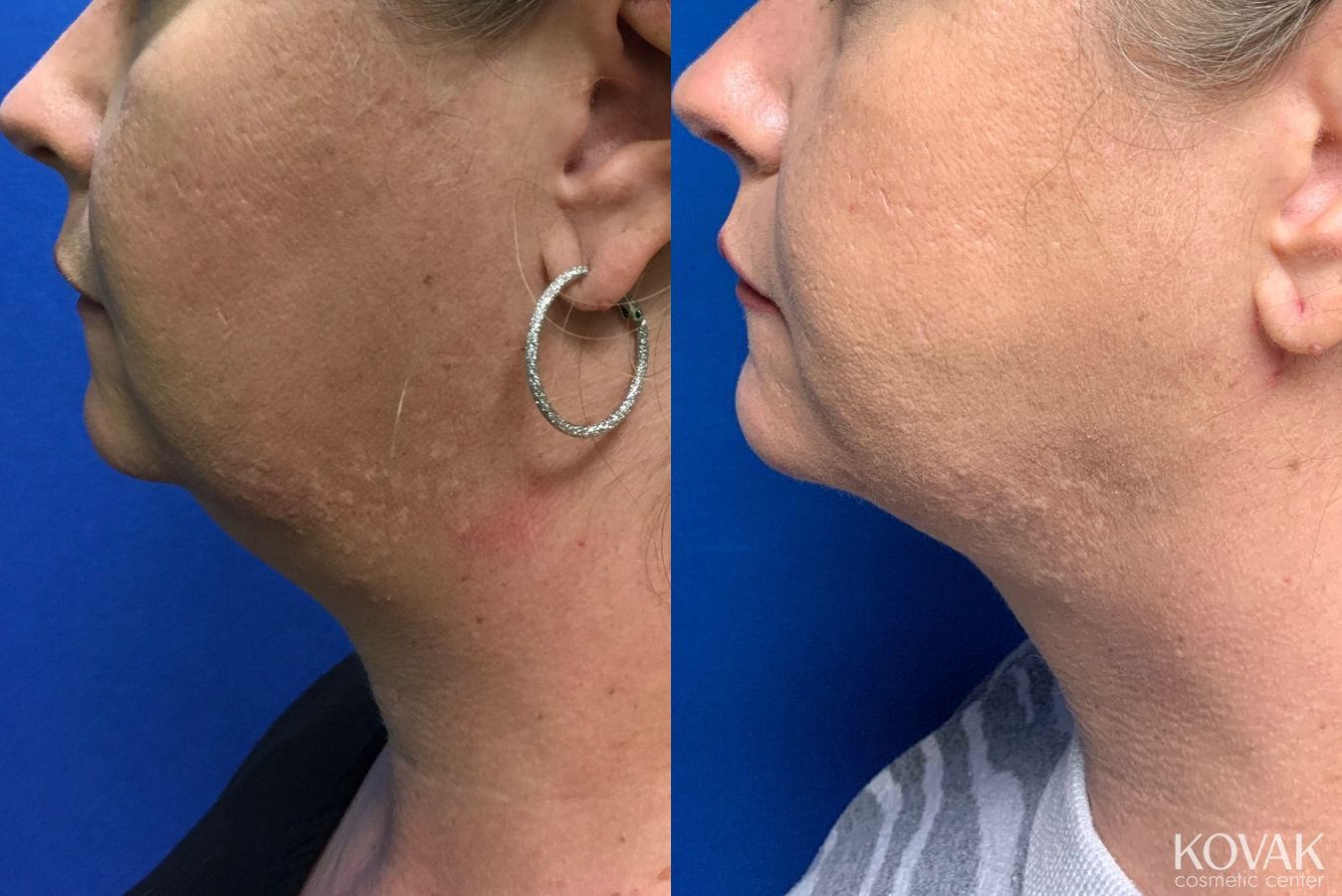Before and after Laser Liposuction case 36691