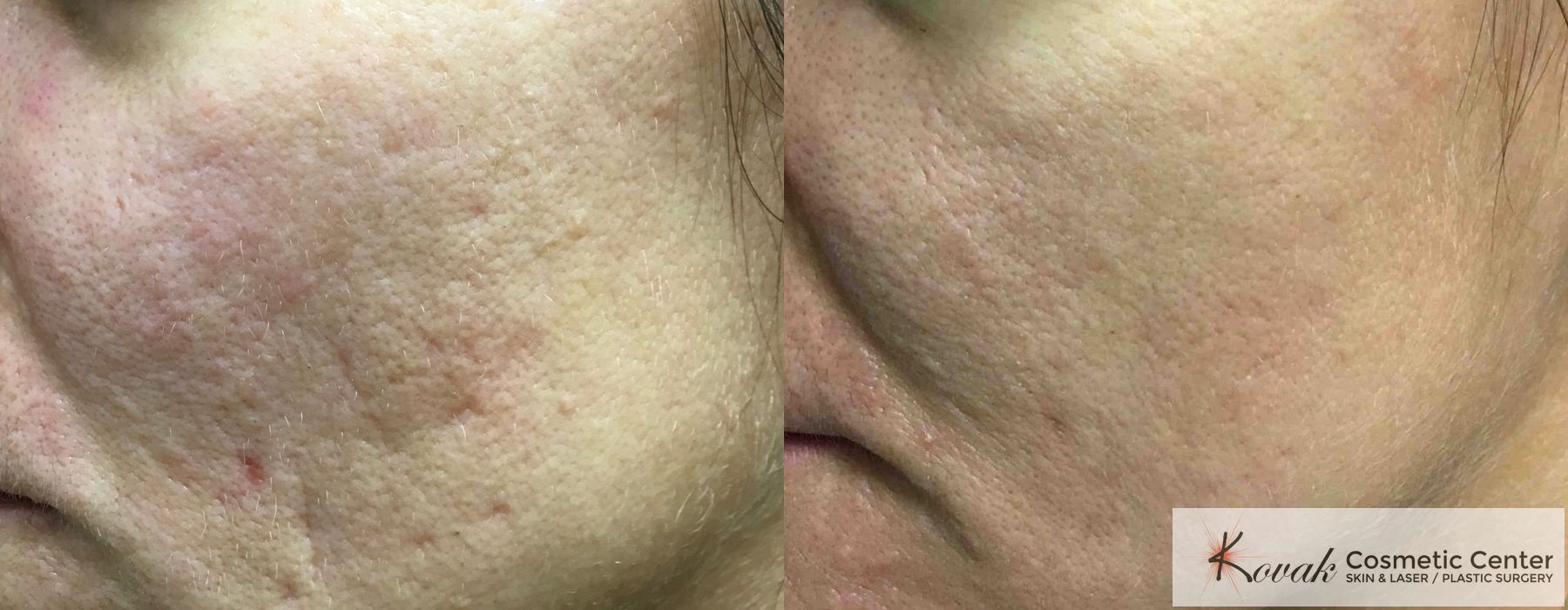 Acne Scars - Case 1569