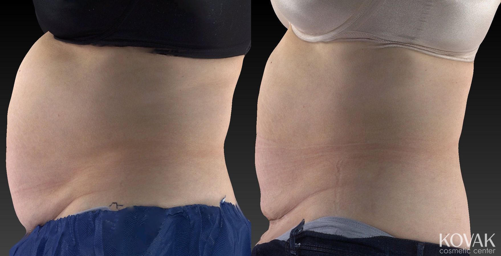 Before and after CoolSculpting® case 36480 - Angle 3