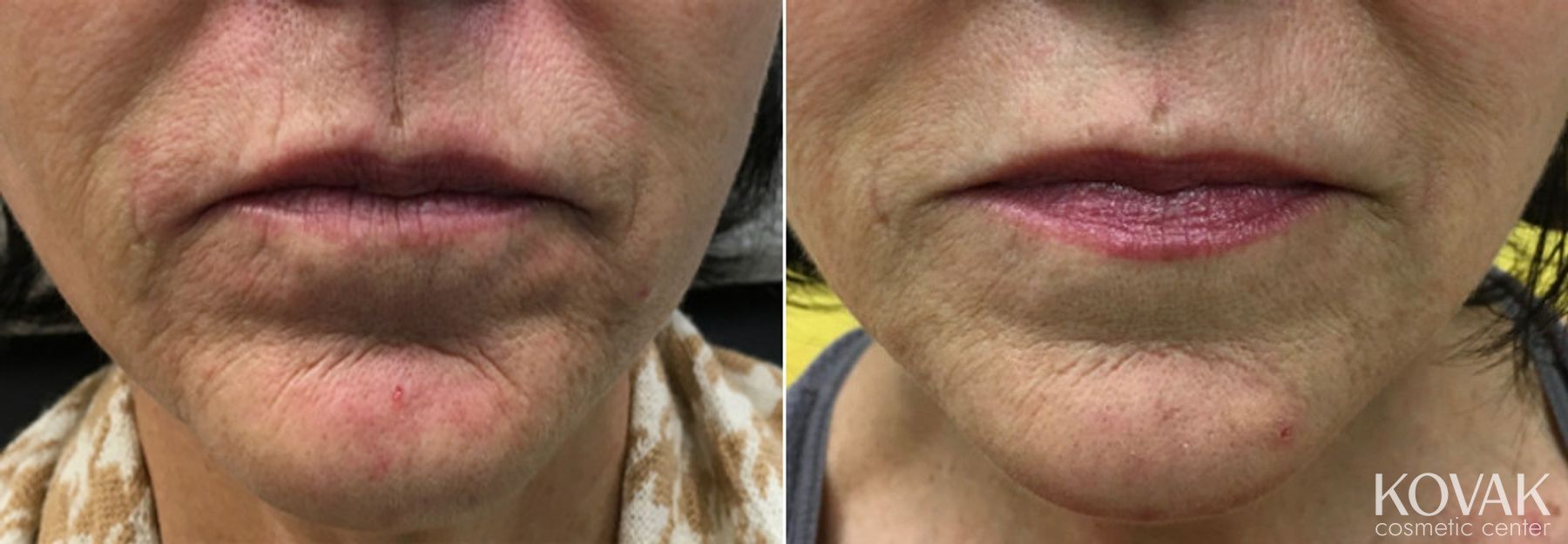 Before and after Restylane® Silk case 36501