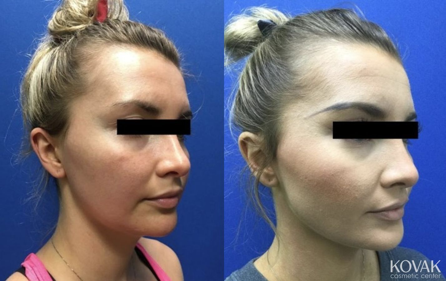 Before and after VLR - Vaser Laser - Jawline Sculpting case 36754 - Angle 2