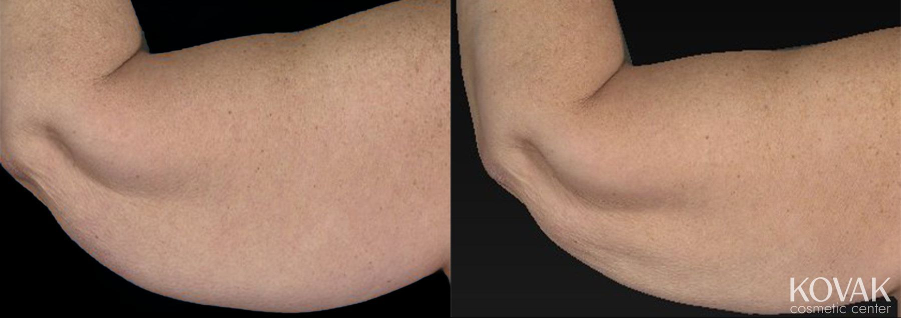 Before and after CoolSculpting® case 36469