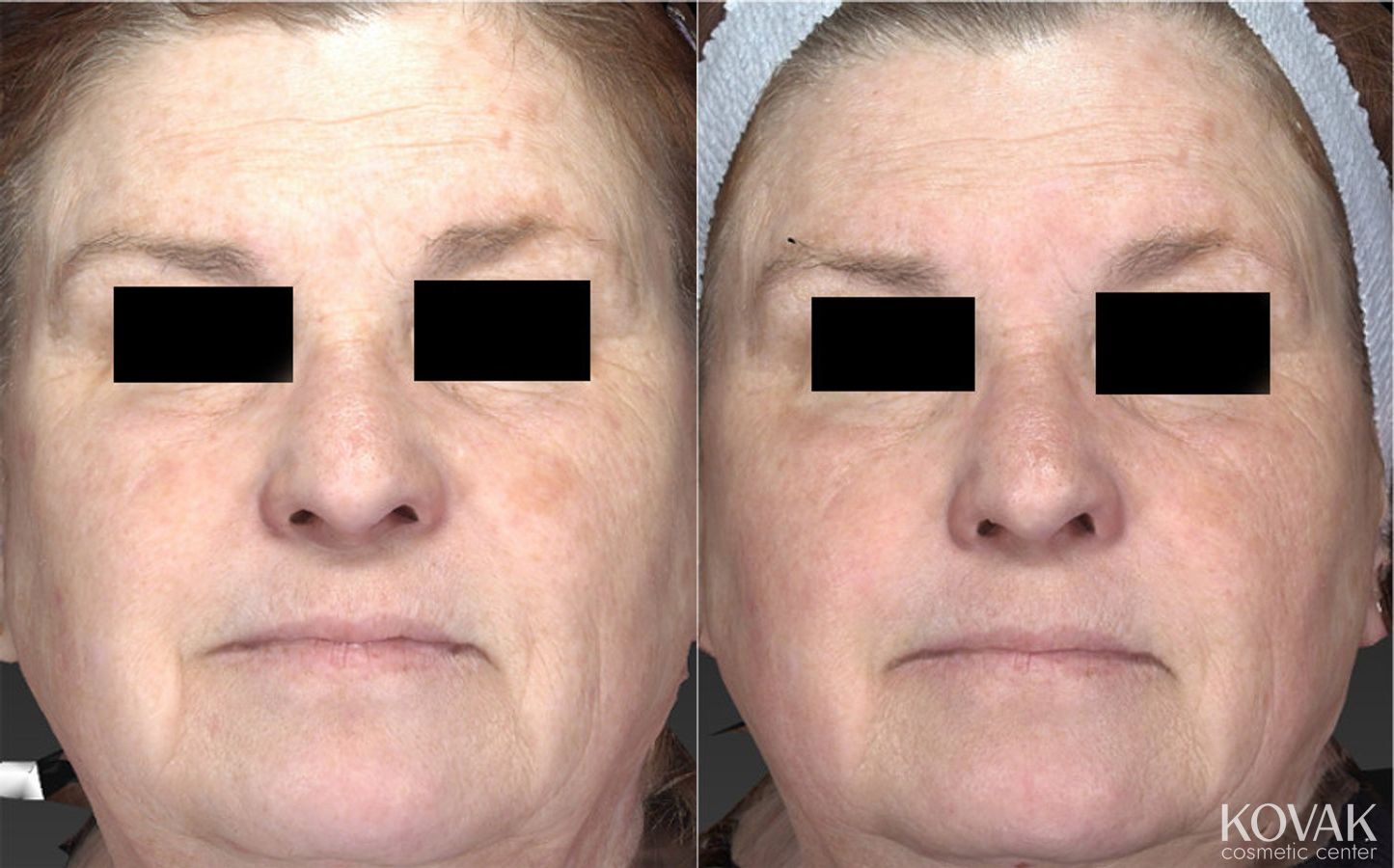 Before and after Halo™ case 36473