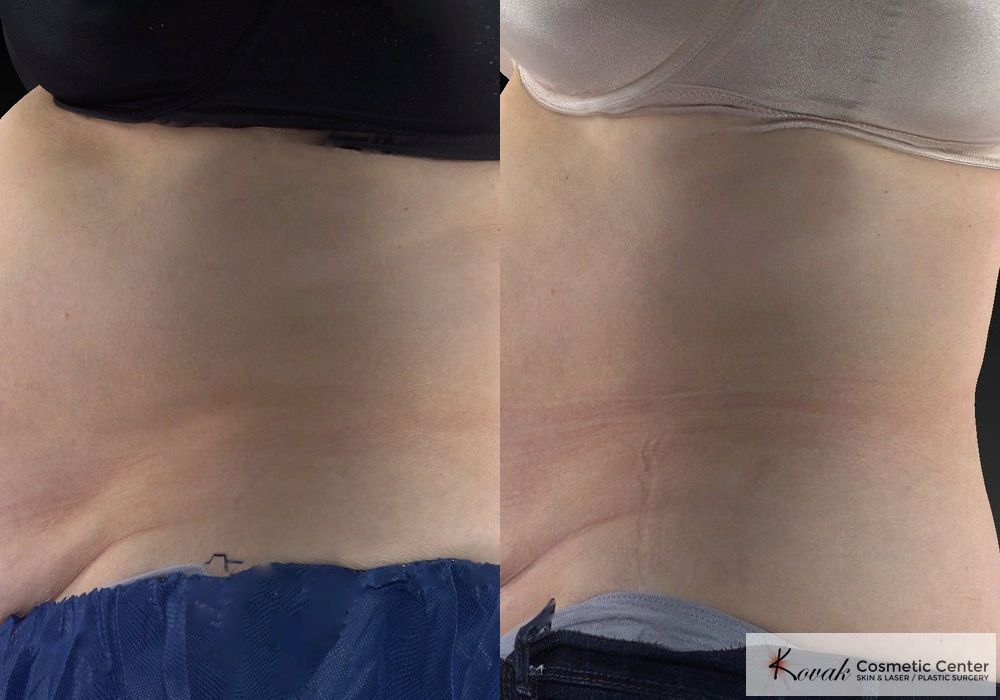 CoolSculpting® - Thumbnail 3