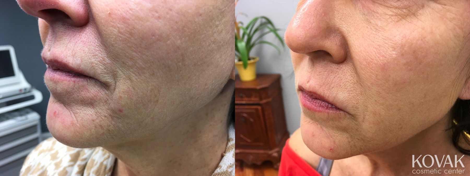 Before and after Restylane® Silk case 36501 - Angle 2