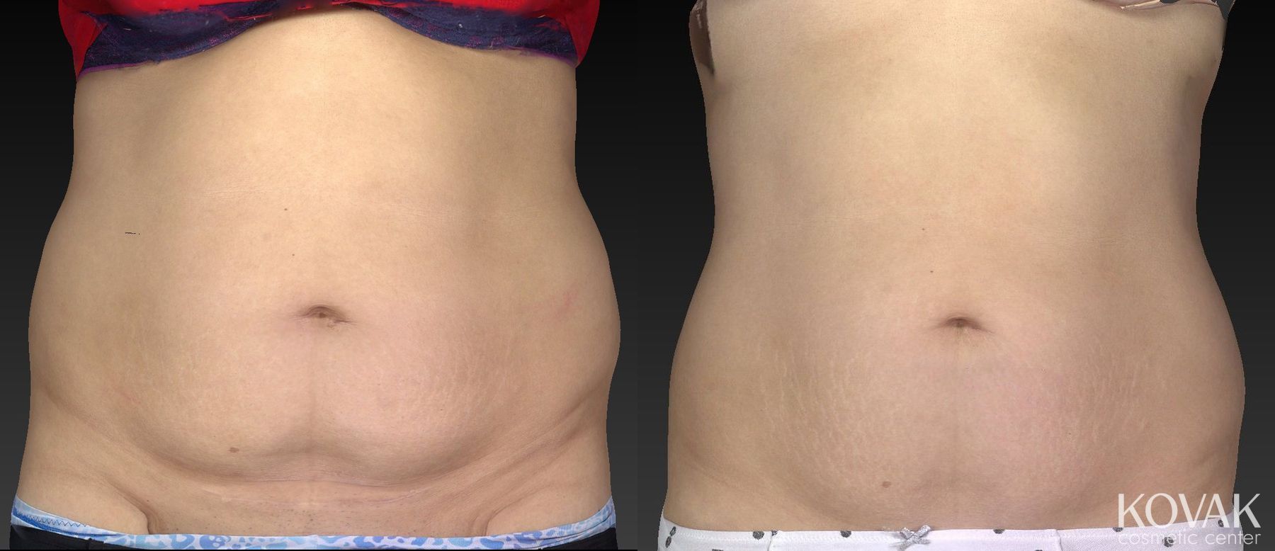 Before and after CoolSculpting® case 36602 - Angle 4
