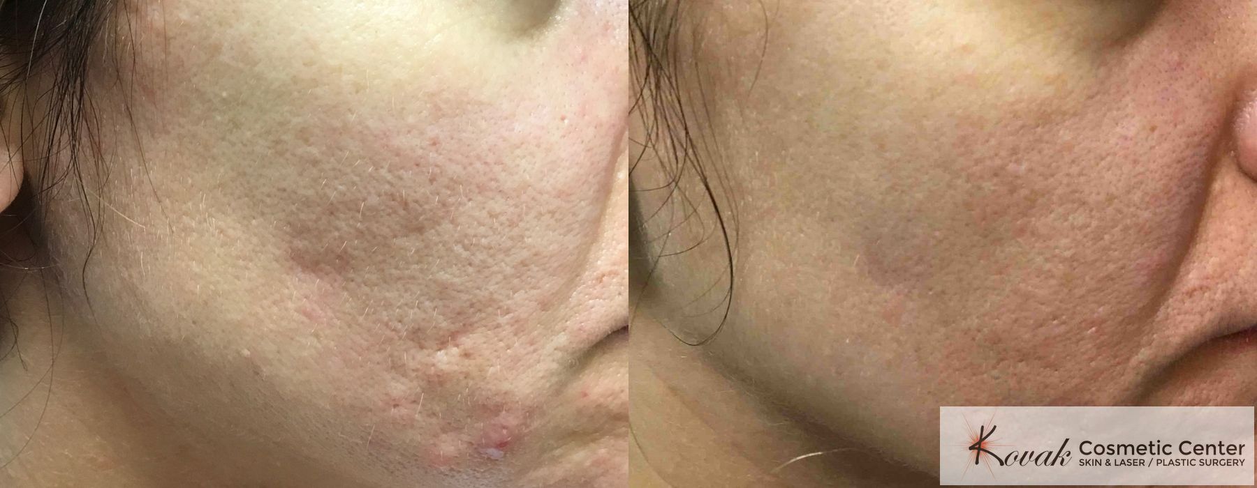 Acne Scars - Thumbnail 2