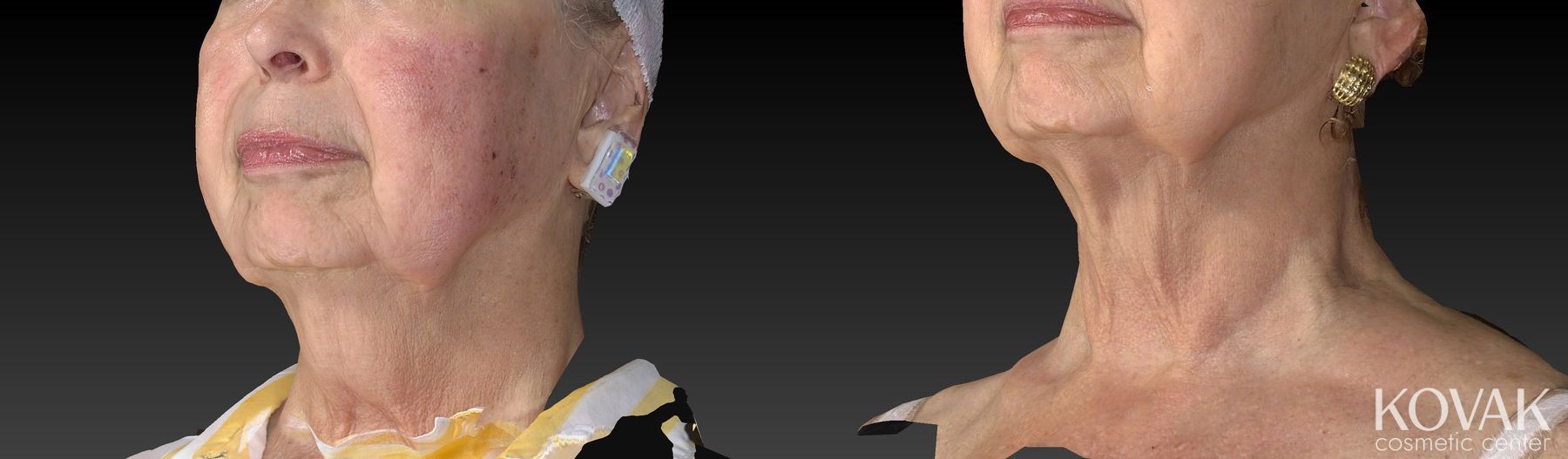 Before and after Kybella case 36525 - Angle 4