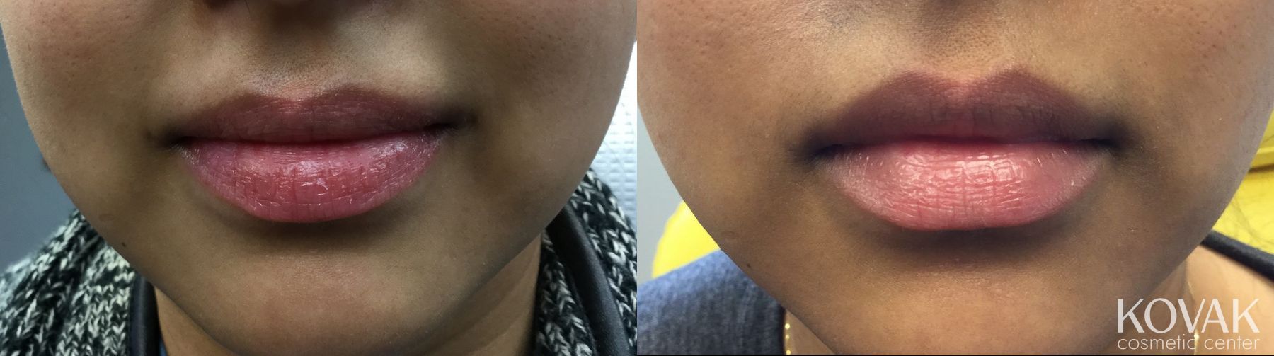 Before and after Juvéderm® XC case 36470