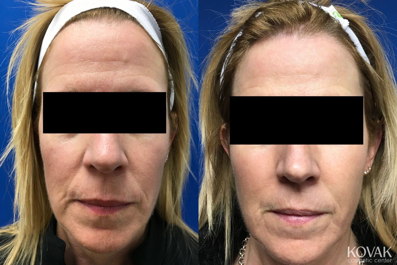 Before and after Facial Volume case 36673