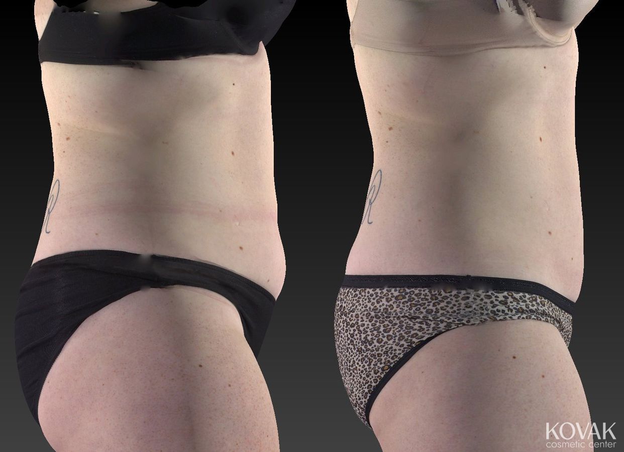 Before and after CoolSculpting® case 36604 - Angle 2