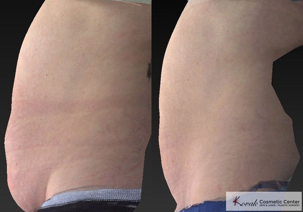 CoolSculpting® - Thumbnail 5