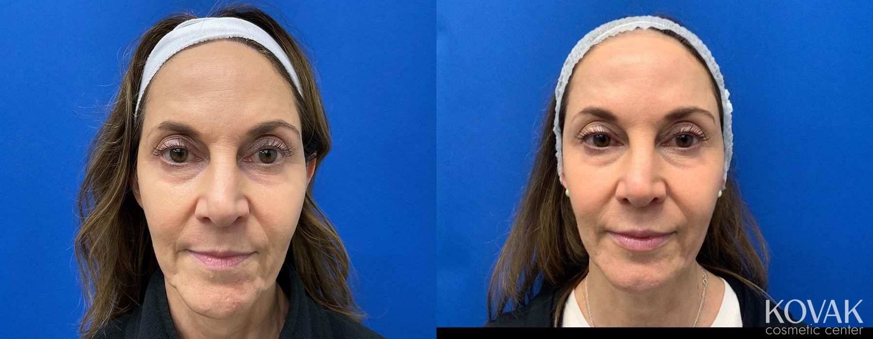 Before and after Facial Rejuvenation case 36751