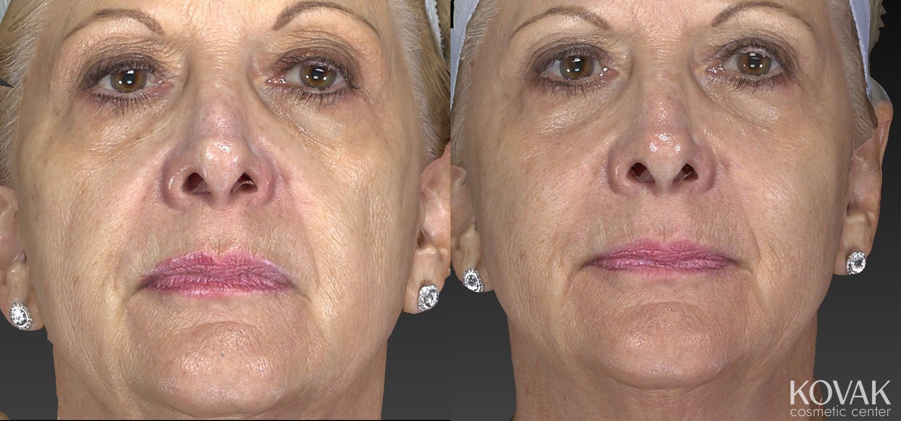 Before and after Injectables - Face case 36537