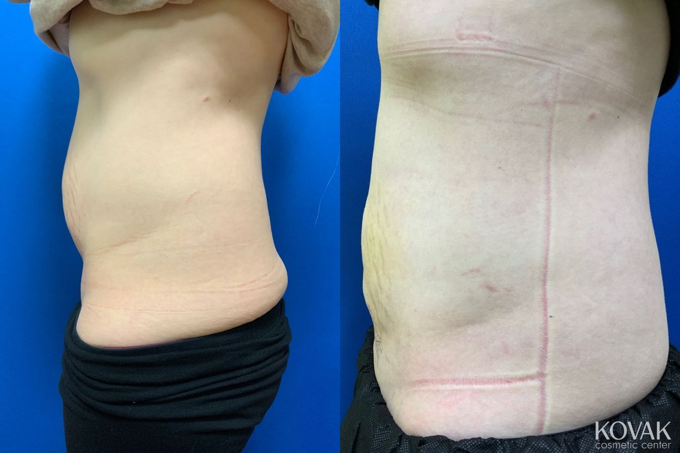 Before and after Laser Liposuction case 36725 - Angle 2