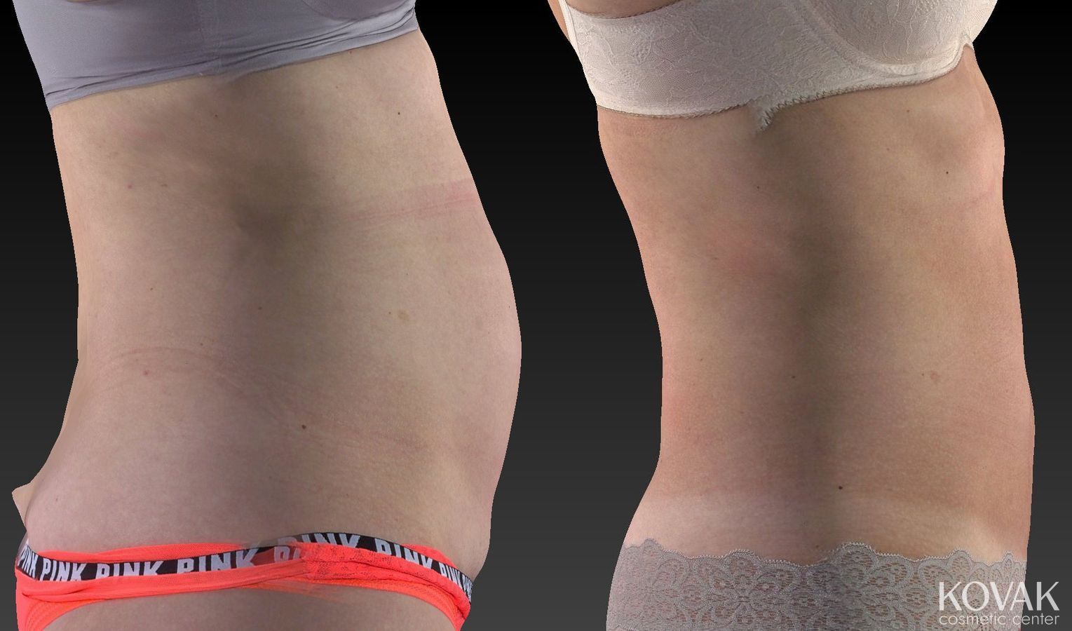 Before and after CoolSculpting® case 36619 - Angle 2