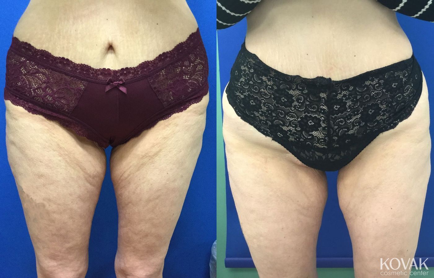Before and after EMSCULPTĀ® case 36686