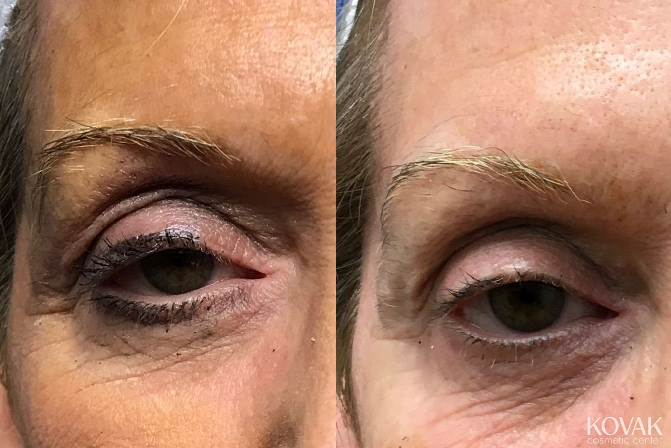 Before and after BOTOX® Cosmetic case 36506