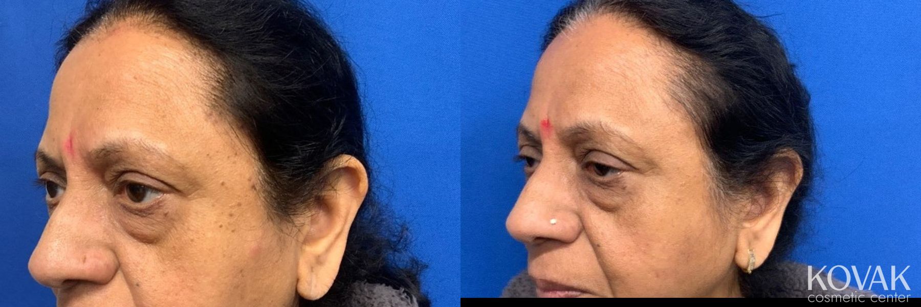 Before and after SEB K case 36777 - Angle 2